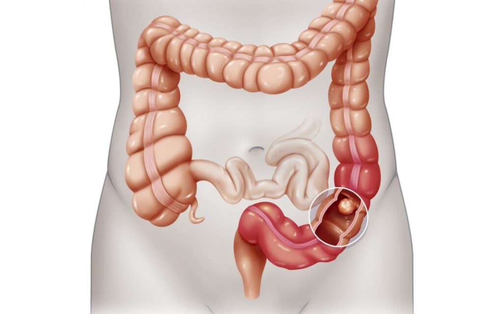 Tumore al colon – retto: quali sono i campanelli d’allarme?