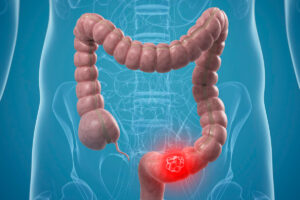 Tumore del colon: i batteri intestinali sono tra le cause? La scoperta