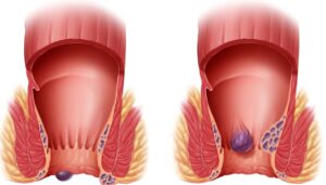 I migliori rimedi naturali per le emorroidi