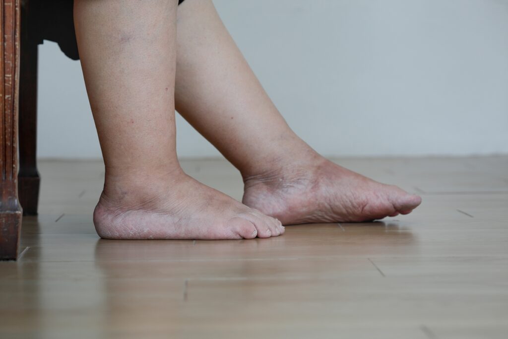 Gambe, caviglie e piedi gonfi: tutte le cause e i possibili rimedi