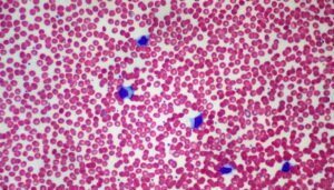 mononucleosi