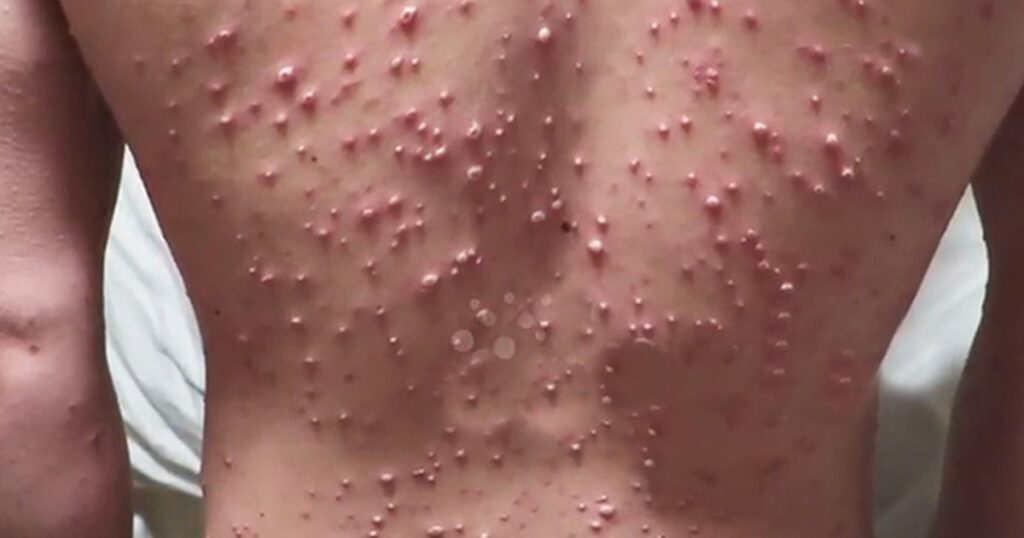 varicella