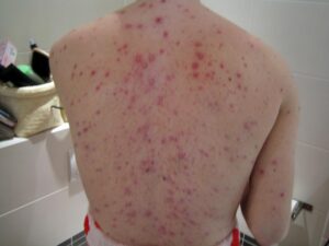 Varicella negli adulti: quali sono i sintomi?