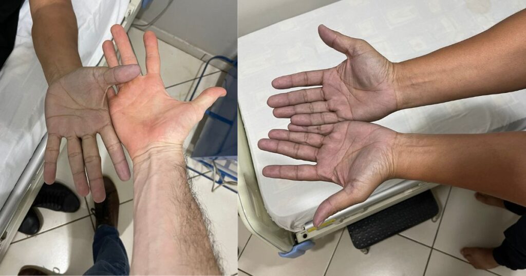 Paziente con le mani blu.