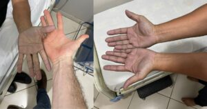 Paziente con le mani blu.