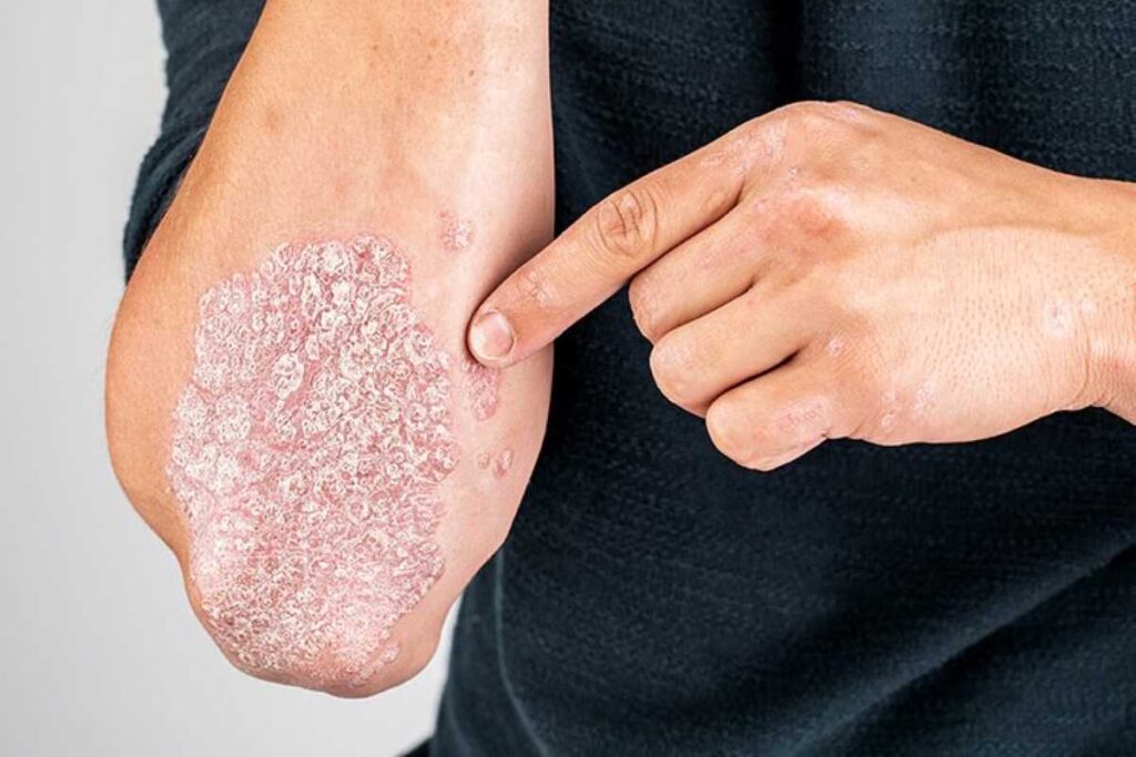 Psoriasi: quali trattamenti?