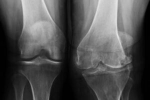 Come salvare il tuo ginocchio dall’artrosi?