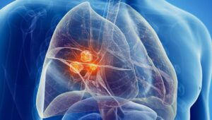 10 cose da sapere sul tumore ai polmoni