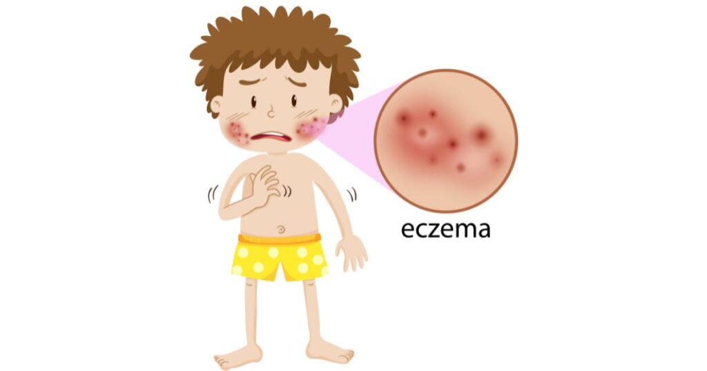 Se hai queste macchie rosse sulla pelle potresti avere l’eczema: i sintomi da non sottovalutare