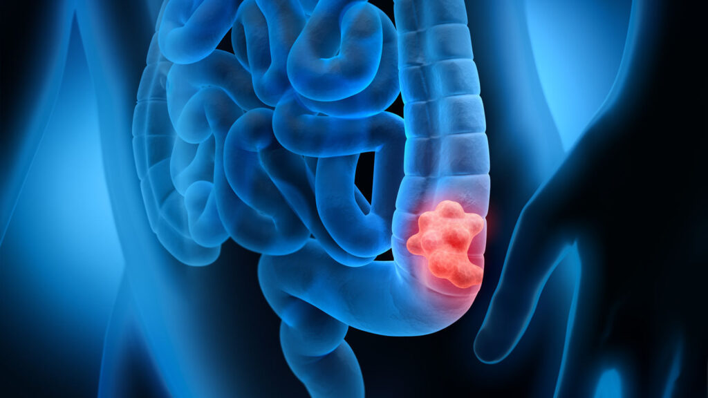 Tumore al colon – retto: trovato punto debole, così è curabile