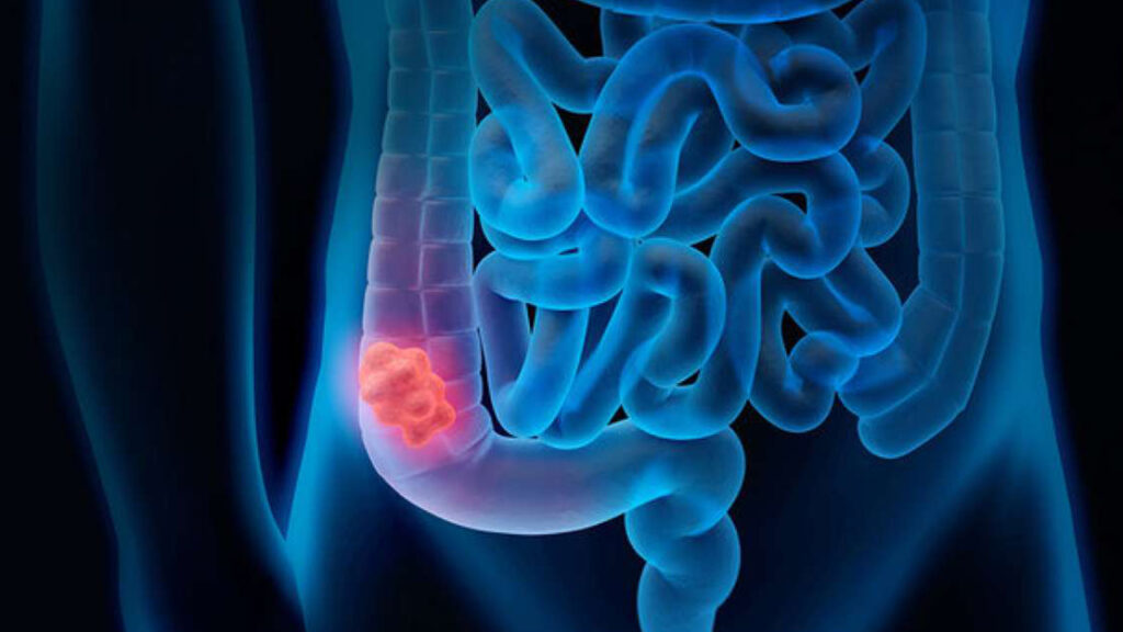 Quali sono i sintomi del tumore al colon – retto?