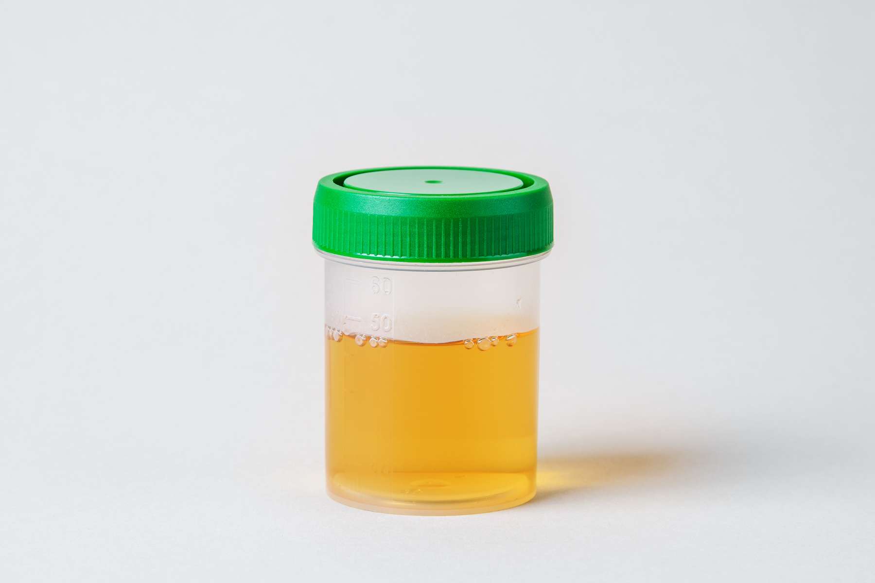 Cosa significa se hai i nitriti nelle urine?