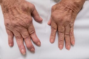 Artrite reumatoide: cos'è, sintomi, prevenzione.