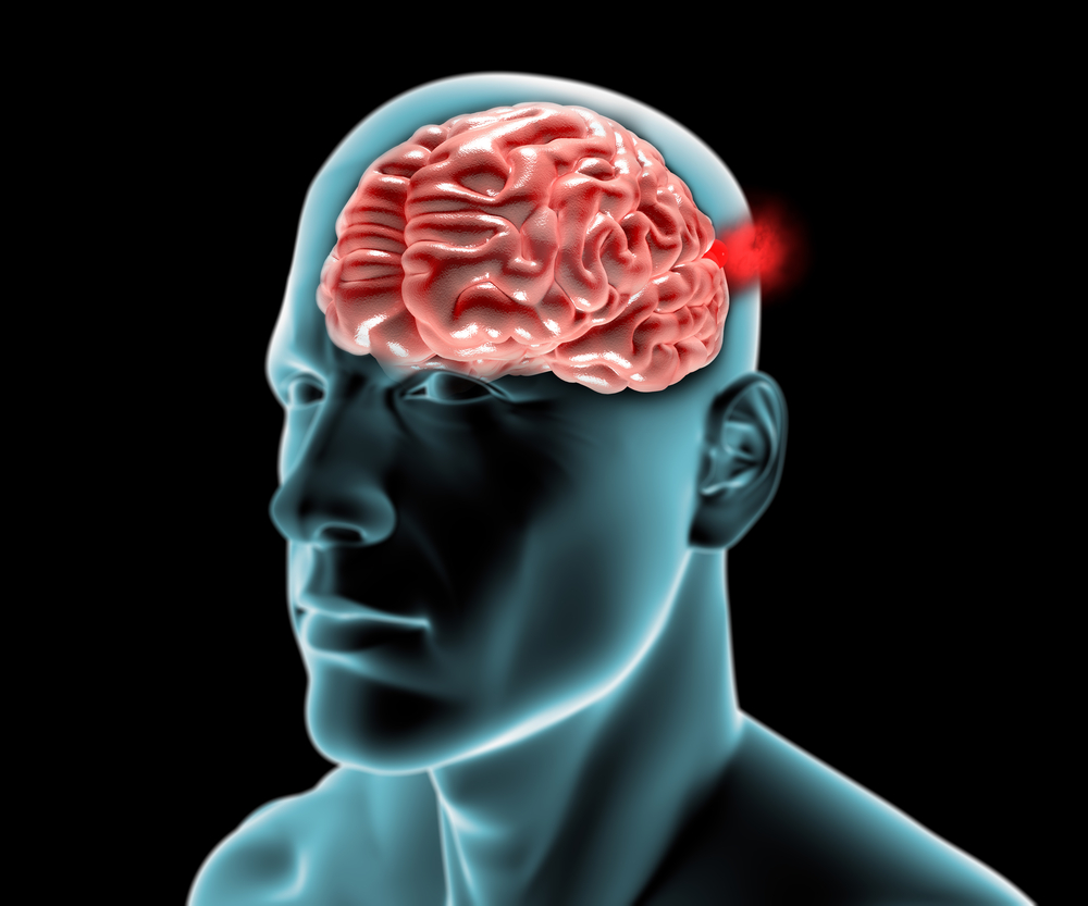 Aneurisma cerebrale: i campanelli d’allarme che devi conoscere