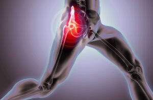 Artrosi dell'anca: i sintomi