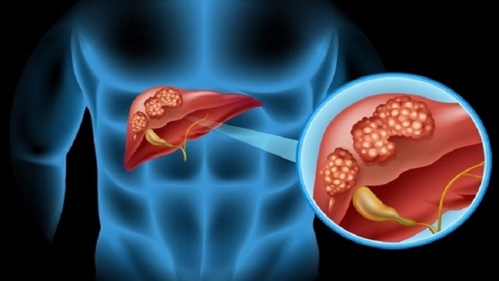 Colangiocarcinoma.