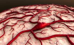 Come prevenire l’ictus cerebrale: ecco cosa devi fare