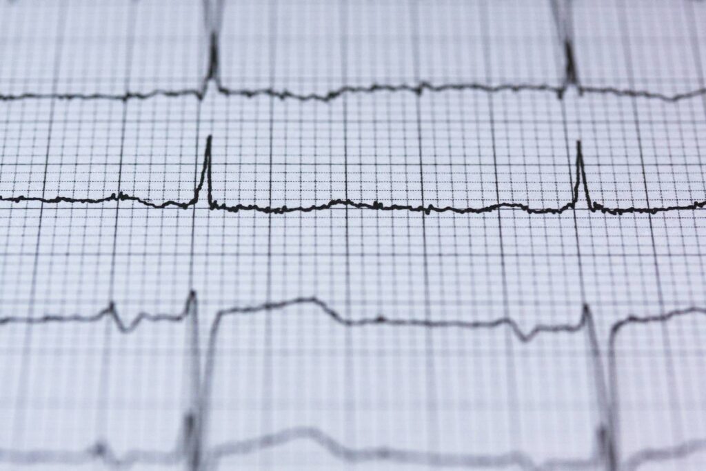 Fibrillazione atriale: cosa fare quando la situazione si fa grave