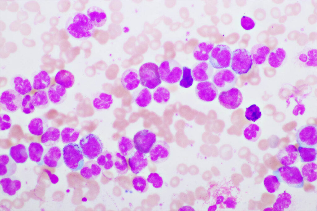 leucemia mielomonocitica