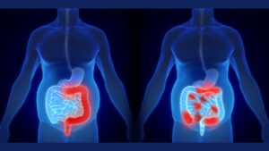 Malattie croniche dell’intestino: cosa devi sapere sui sintomi