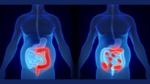 Malattie croniche dell’intestino: cosa devi sapere sui sintomi