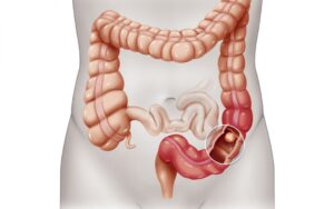 Cancro al colon-retto: conosci i sintomi da non sottovalutare