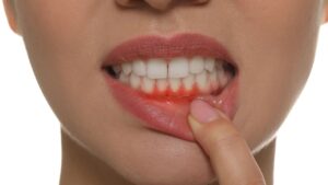 Cosa succede se non ti lavi i denti per una settimana? Ecco la risposta