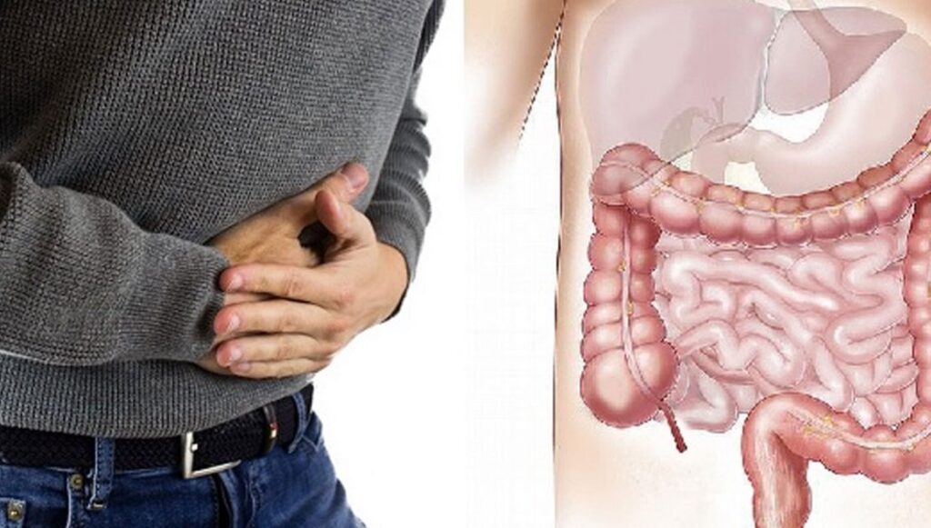 morbo di Crohn