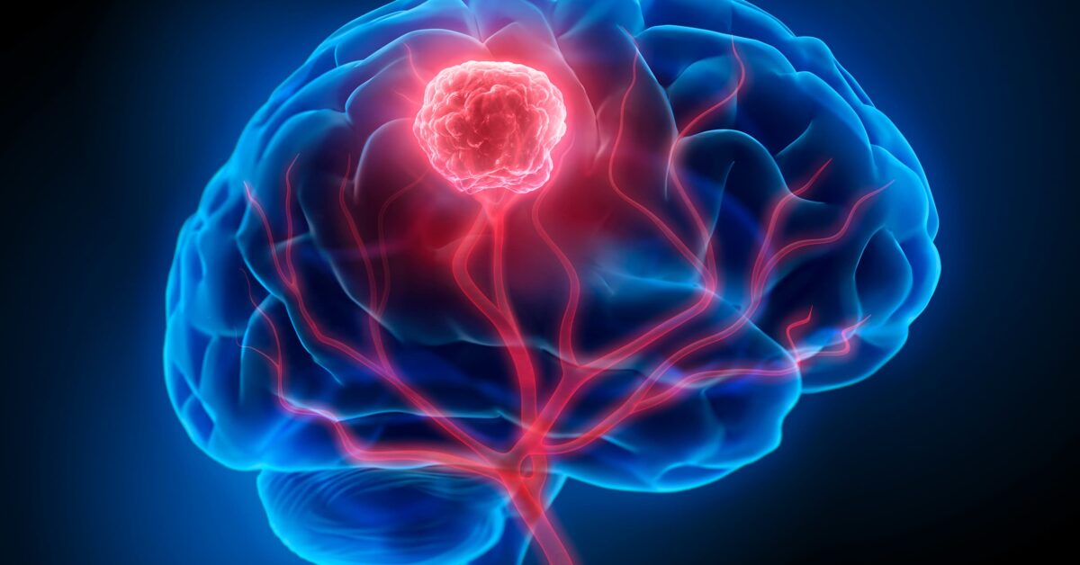 Tumore al cervello: quali sono i sintomi che devono insospettire?