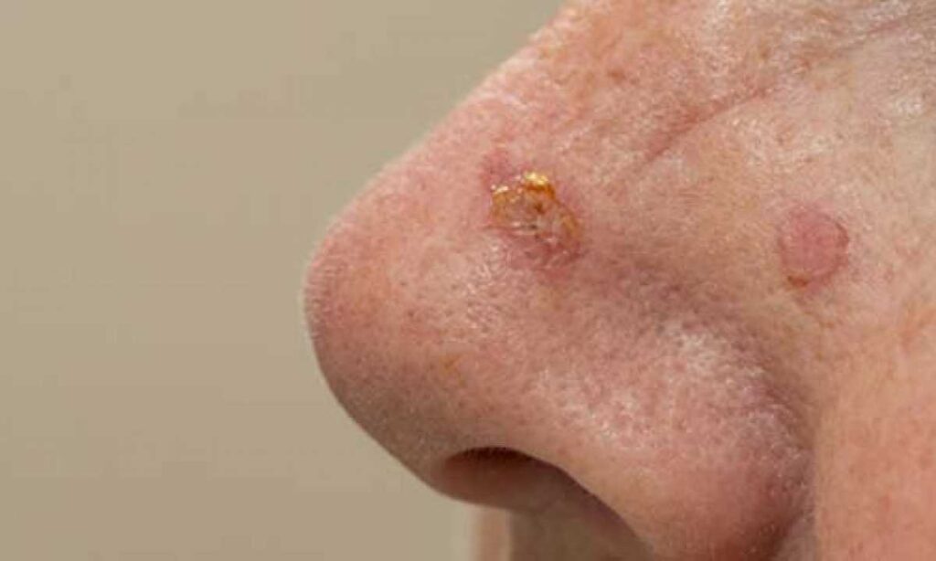 Tumore al naso: tutto quello che devi sapere