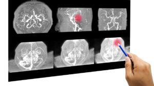 Aneurisma: i campanelli d’allarme