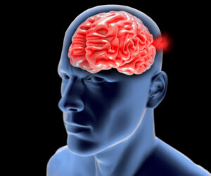 Aneurisma nel cervello: scopri i segnali d’avviso