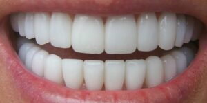 Denti bianchi.