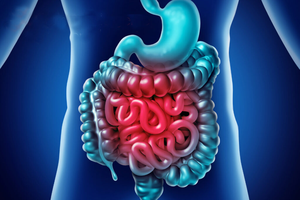 diverticoli