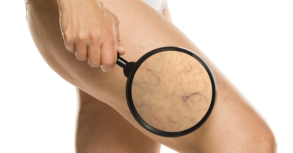 Flebite alle gambe negli over 60: quali sono i sintomi e le cure?