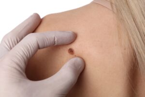 Melanoma: quali sono i segnali d’avviso? A cosa devi fare attenzione