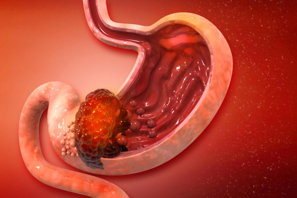 Tumore allo stomaco: i segnali d’avviso da conoscere