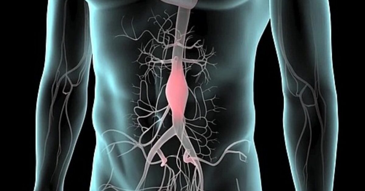 Aneurisma dell'aorta addominale sintomi, cause e
