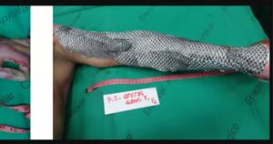 Paziente con il braccio ustionato, ha ricevuto un innesto di pelle di pesce: il caso bizzarro