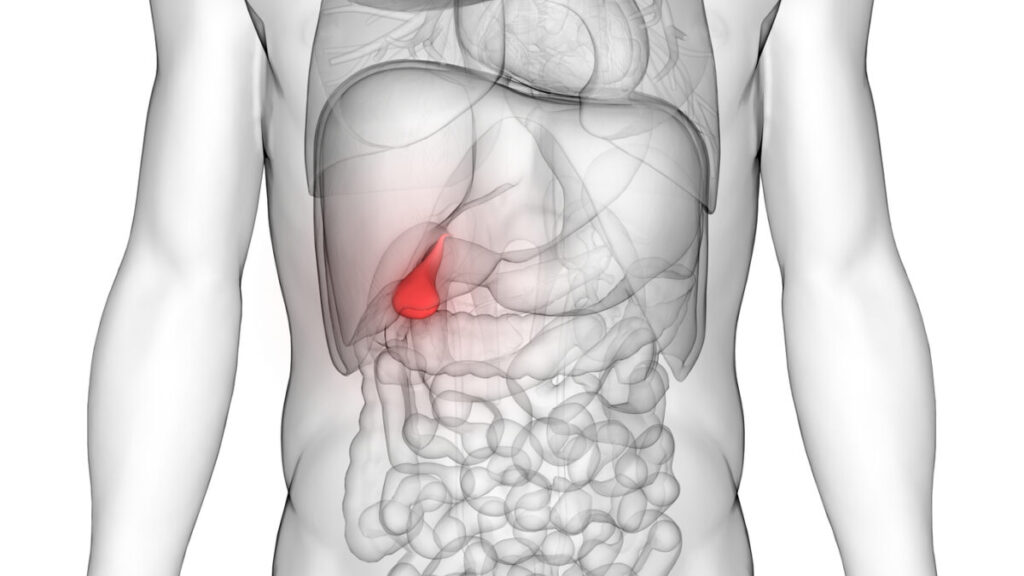 Cancro alla cistifellea: segni e sintomi comuni