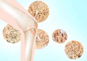 Osteoporosi: quali sono i sintomi iniziali?