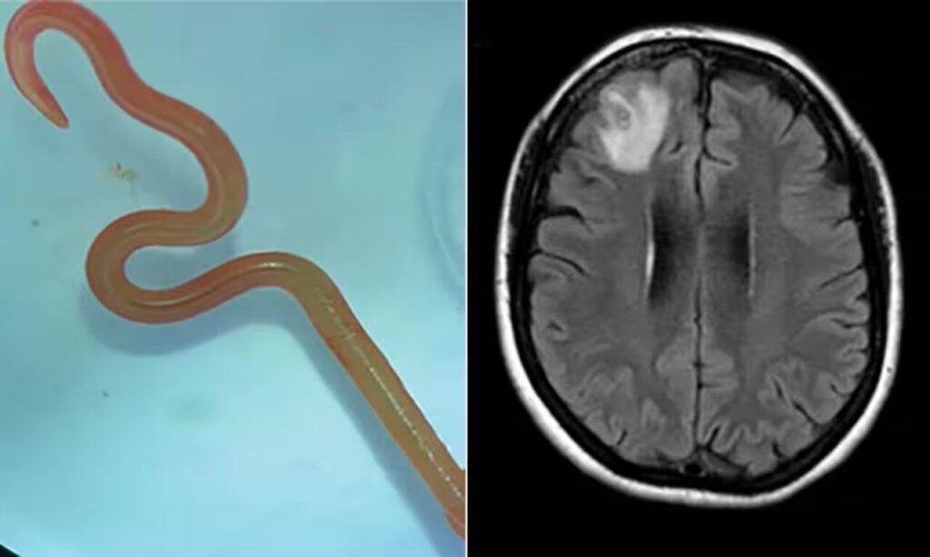 Ha un verme vivo nel cervello: 64enne salvata dai medici