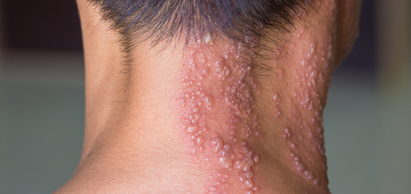 Diffuse Zoster Herpes zoster: quali sono i sintomi iniziali?