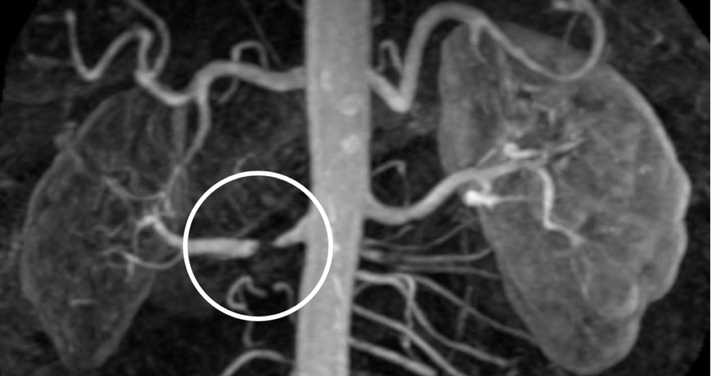 Stenosi dell’arteria renale: i segnali di avviso