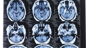 Soffre di emicrania, medici scoprono un oggetto nel cervello