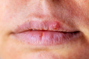 Labbra sanguinanti: quali sono le cause più comuni?