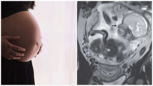 Feto nell’intestino: raro caso di gravidanza ectopica