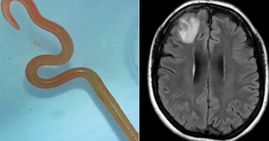 Soffre di emicranie: medici scoprono un parassita nel cervello