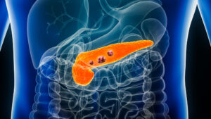 Tumore al pancreas, segnali di avviso: a cosa fare attenzione
