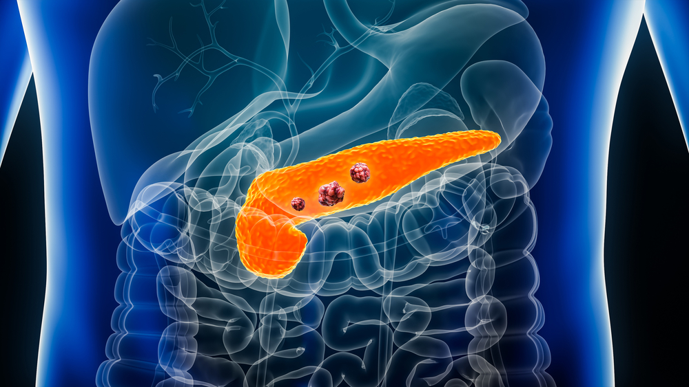 Cancro al pancreas